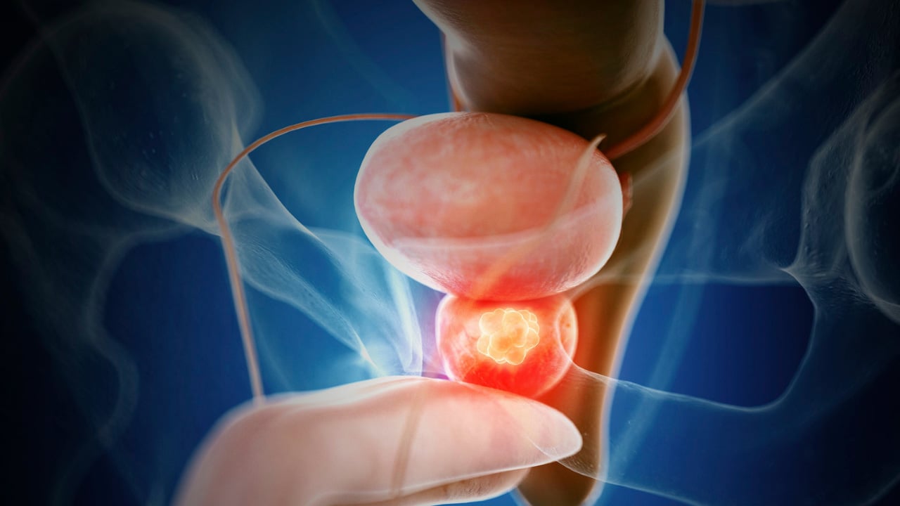 Foto - Kanser için yeni nesil araştırmalar çareyi buldu: İlaç prostat kanseriyle mücadele ediyor! Hayrete düşürdü