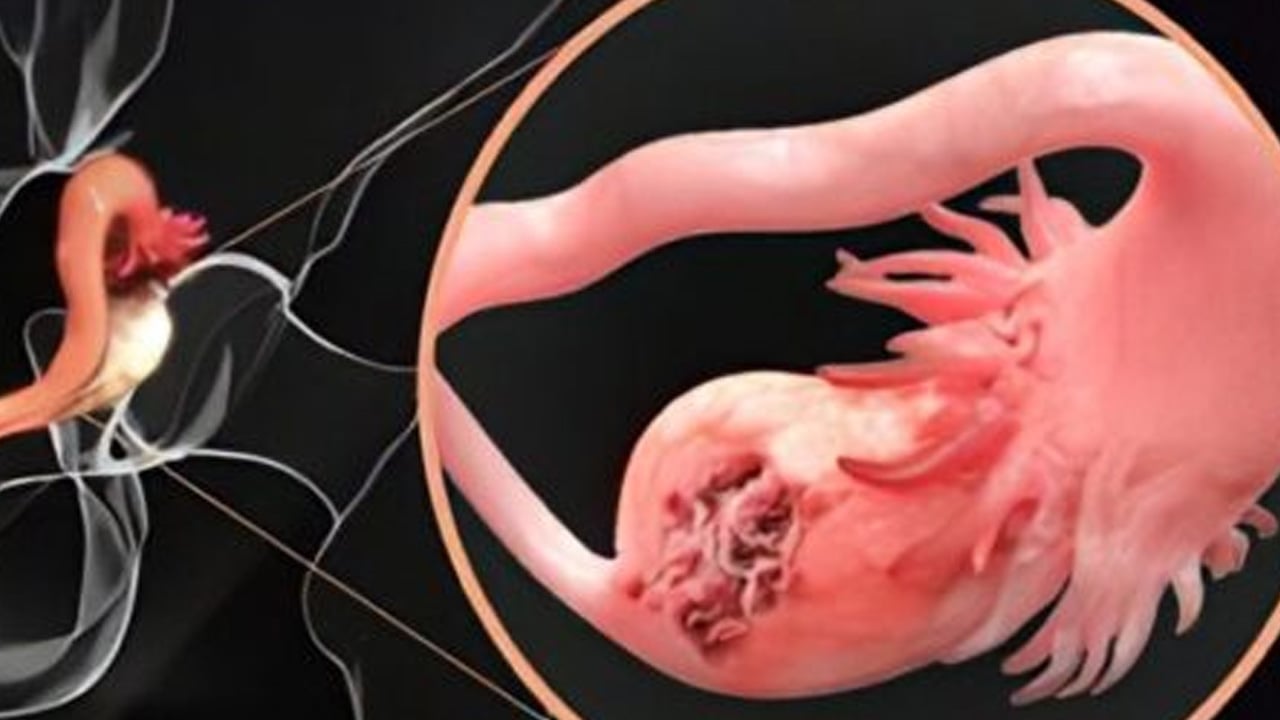 Kansere karşı kalkan oluyor: Ezber bozan devrimsel mRNA aşısı... İki Üniversite bakın nasıl önlem alacak