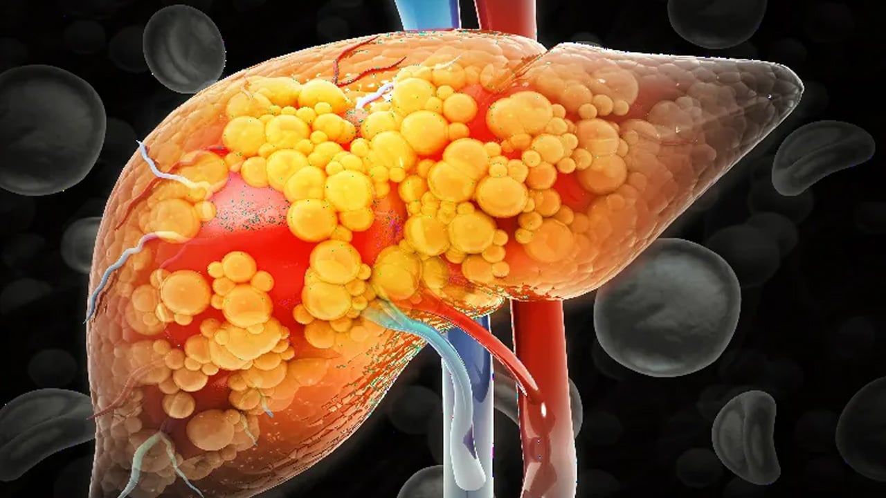Karaciğer yağlanması olanlara büyük müjde: Semaglutid MASH test sonucunu verdi