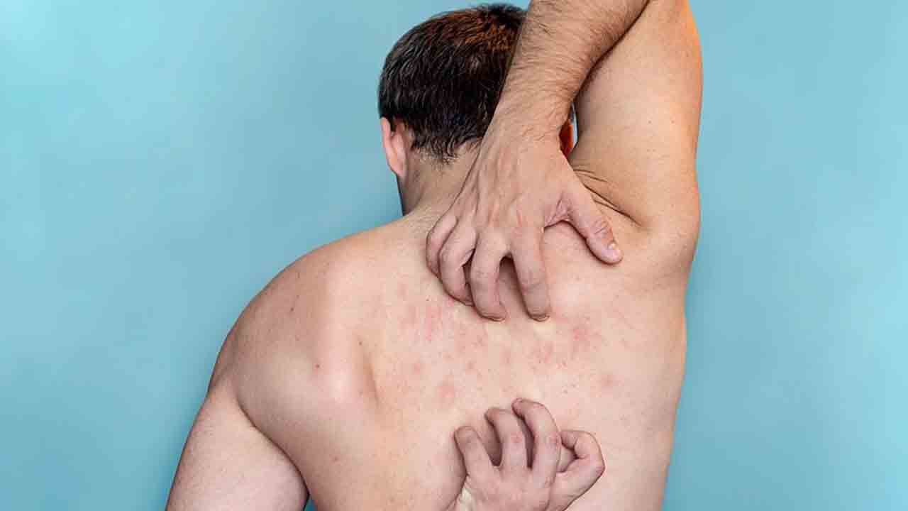 Kaşıntı kabusu geri döndü: Uyuz vakaları tırmanışta