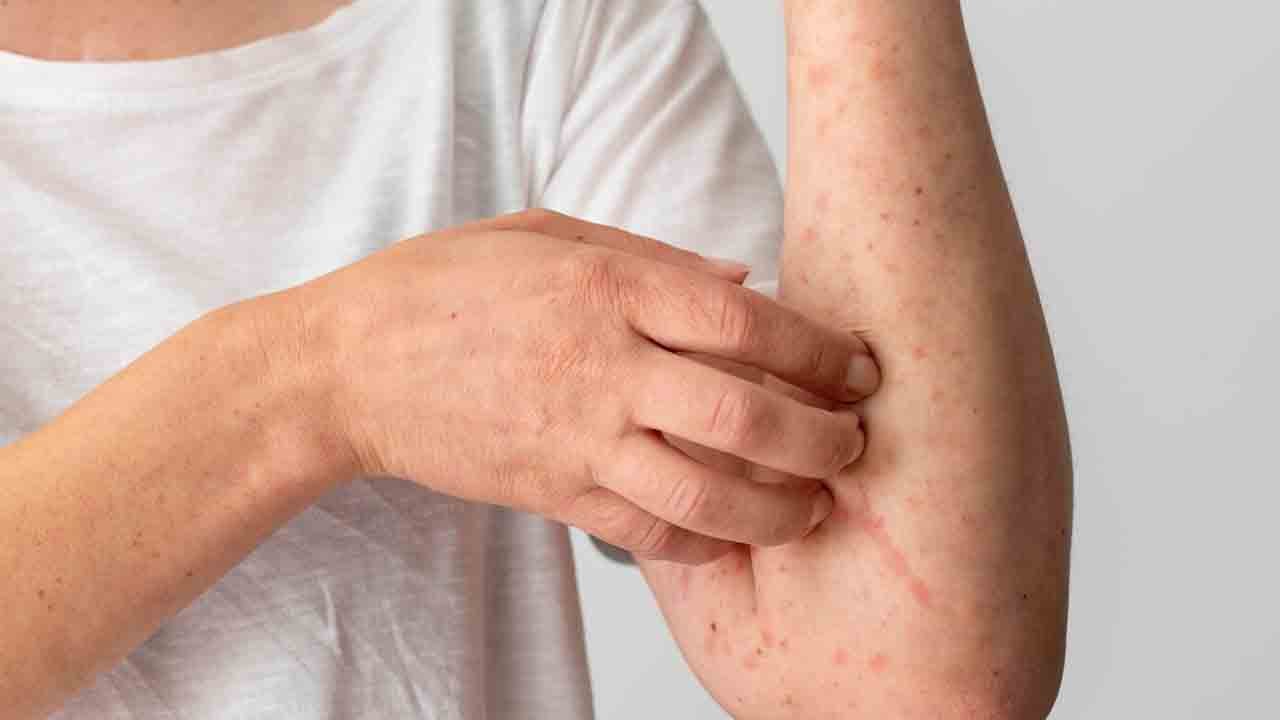 Foto - Kaşıntı kabusu geri döndü: Uyuz vakaları tırmanışta