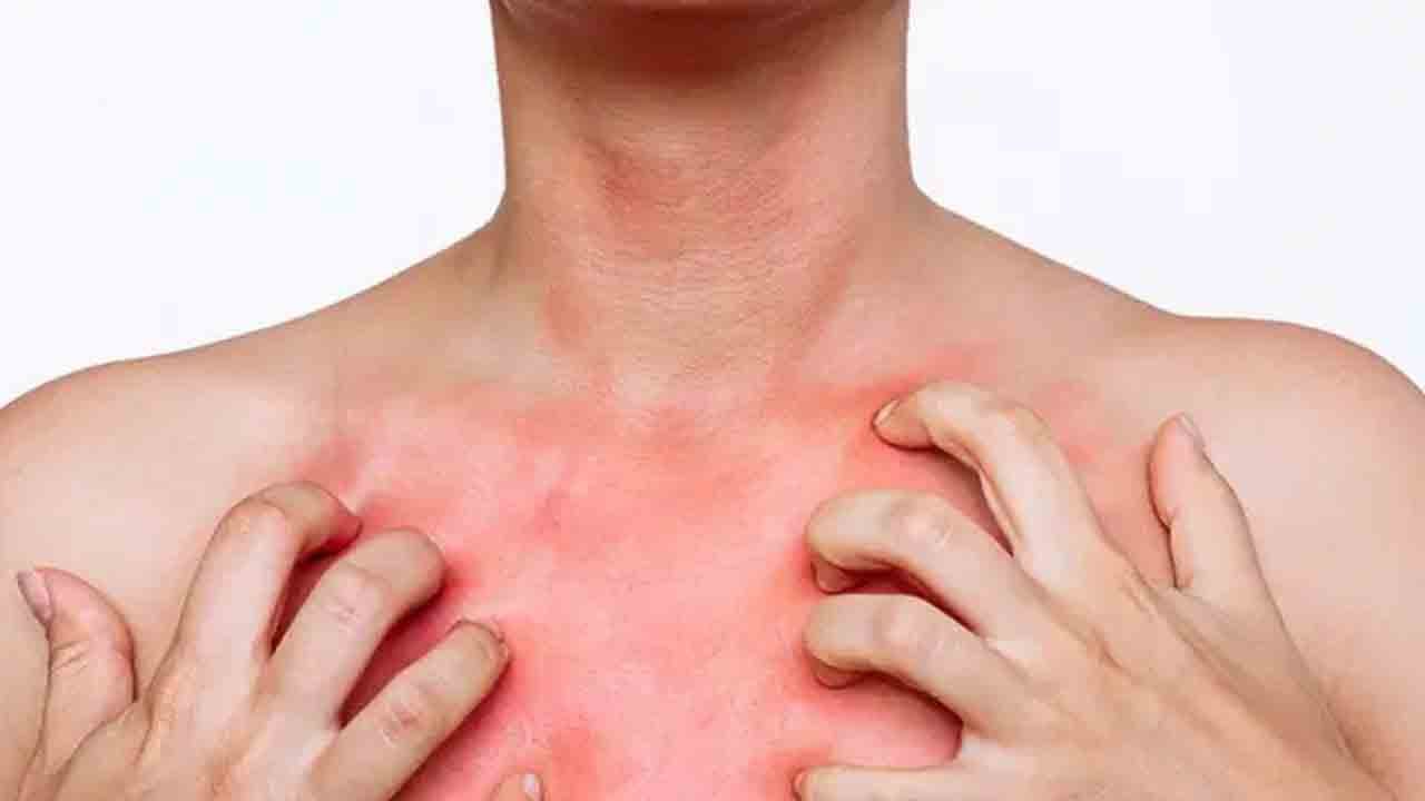 Foto - Kaşıntı kabusu geri döndü: Uyuz vakaları tırmanışta