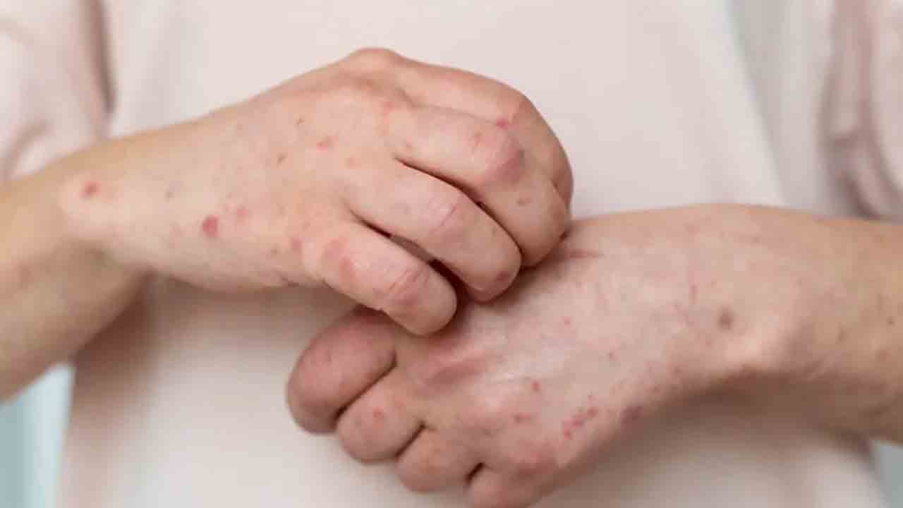 Foto - Kaşıntı kabusu geri döndü: Uyuz vakaları tırmanışta