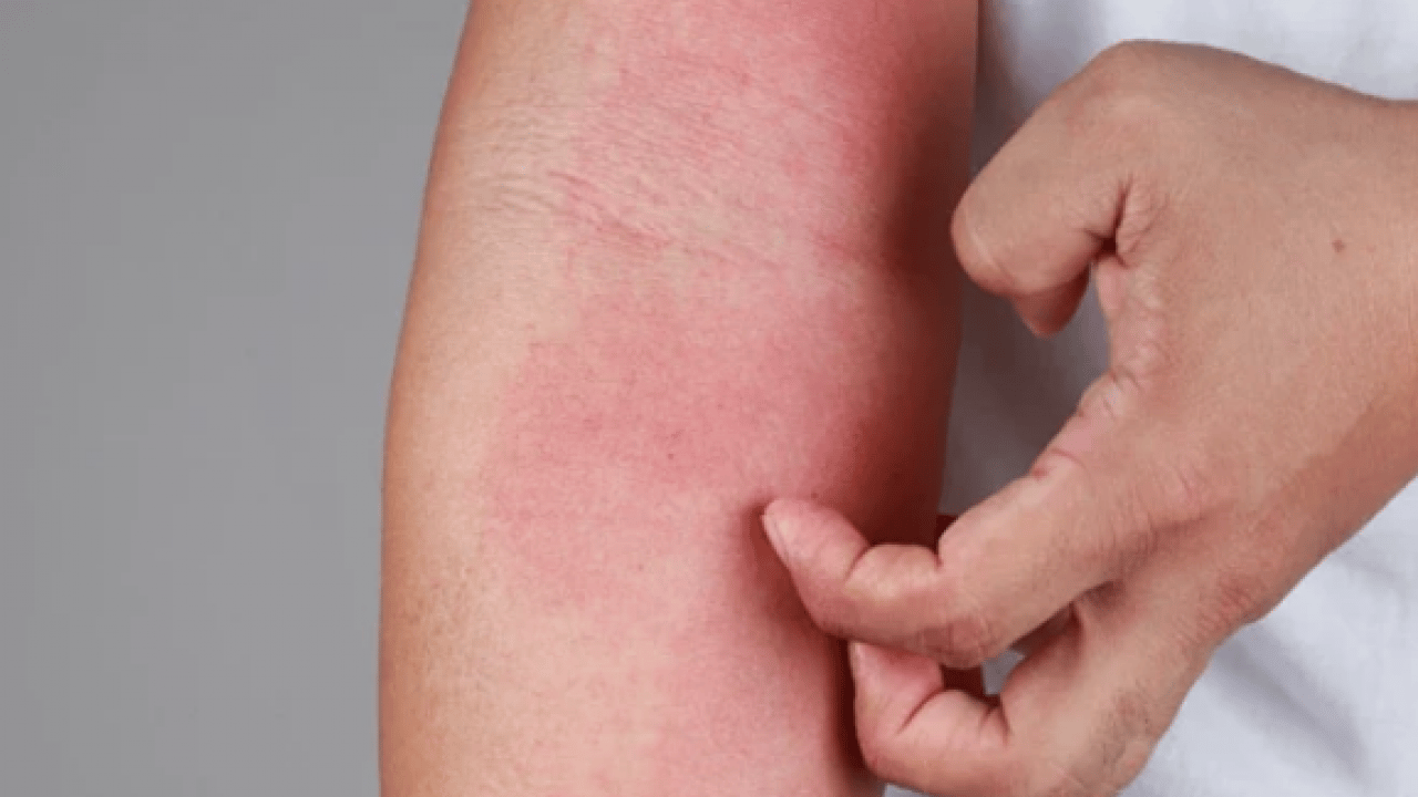 Foto - Kaşıntıya naneli çözüm! Kaşıntıya karşı öneri: Hem pişirin hem suyunu kullanın diyor! İşte formül, kullanım süresi