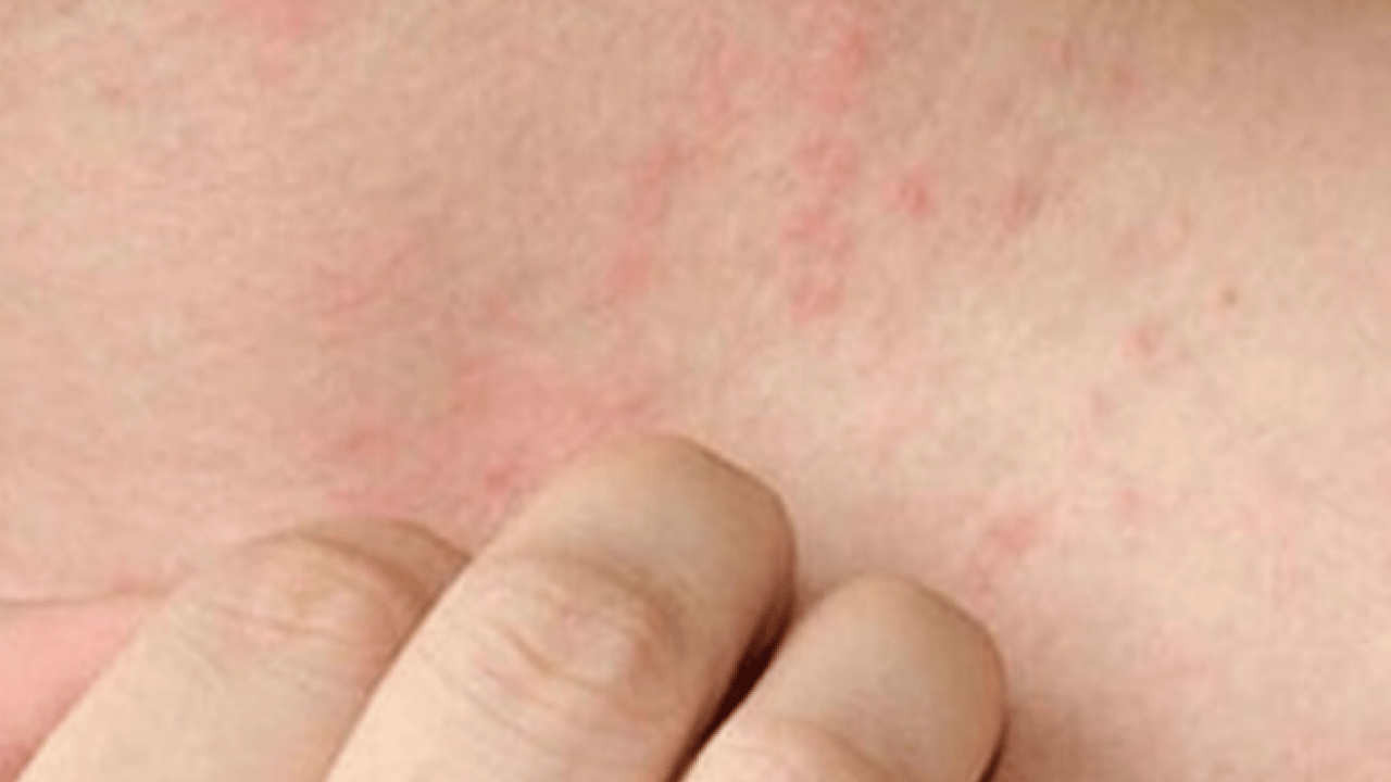 Foto - Kaşıntıya naneli çözüm! Kaşıntıya karşı öneri: Hem pişirin hem suyunu kullanın diyor! İşte formül, kullanım süresi