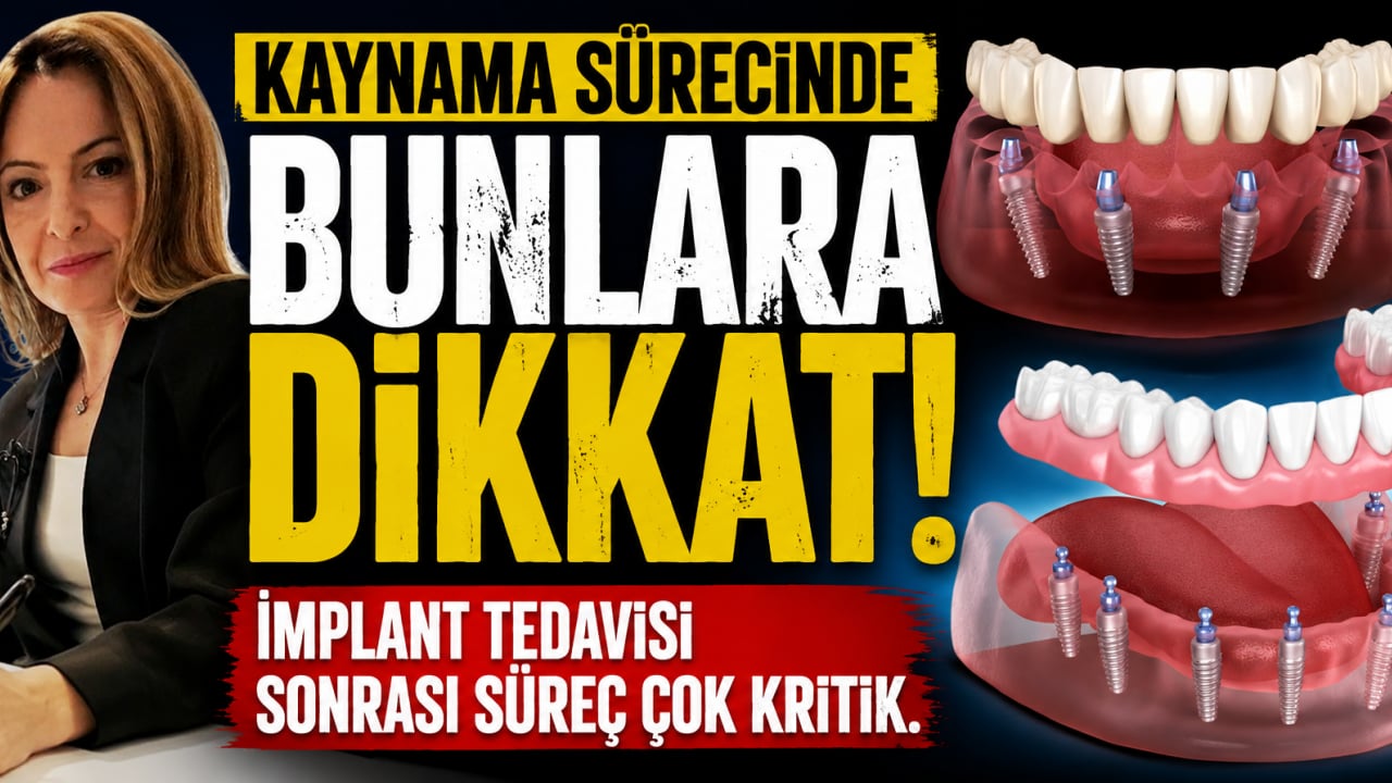 Kaynama sürecinde bunlara dikkat! İmplant tedavisi sonrası süreç çok kritik