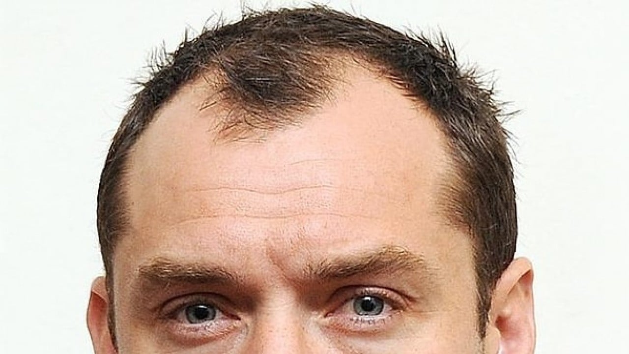 Foto - Kellik sorunu tarihe karışıyor!