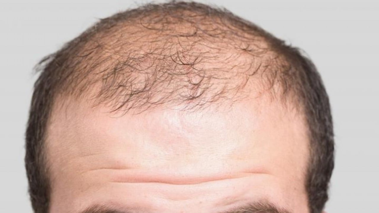 Foto - Kellik sorunu tarihe karışıyor!