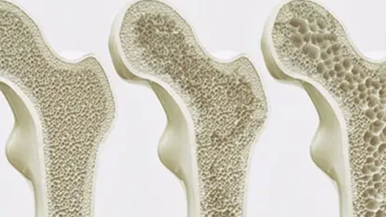 Foto - Kemik erimesi olarak bilinen Osteoporoz yatağa mahkum ediyor! Kemik erimesine karşı 7 etkili öneri