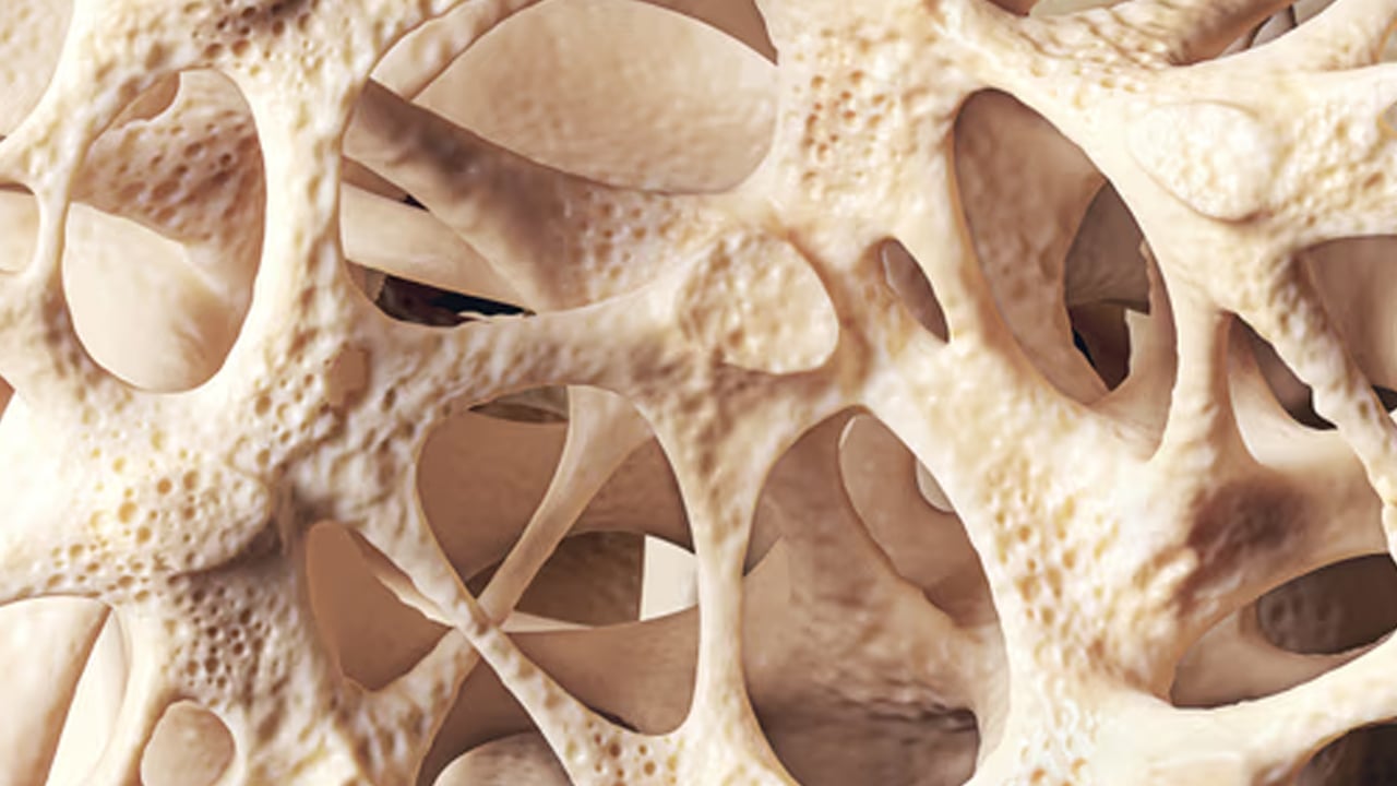 Foto - Kemik erimesi olarak bilinen Osteoporoz yatağa mahkum ediyor! Kemik erimesine karşı 7 etkili öneri