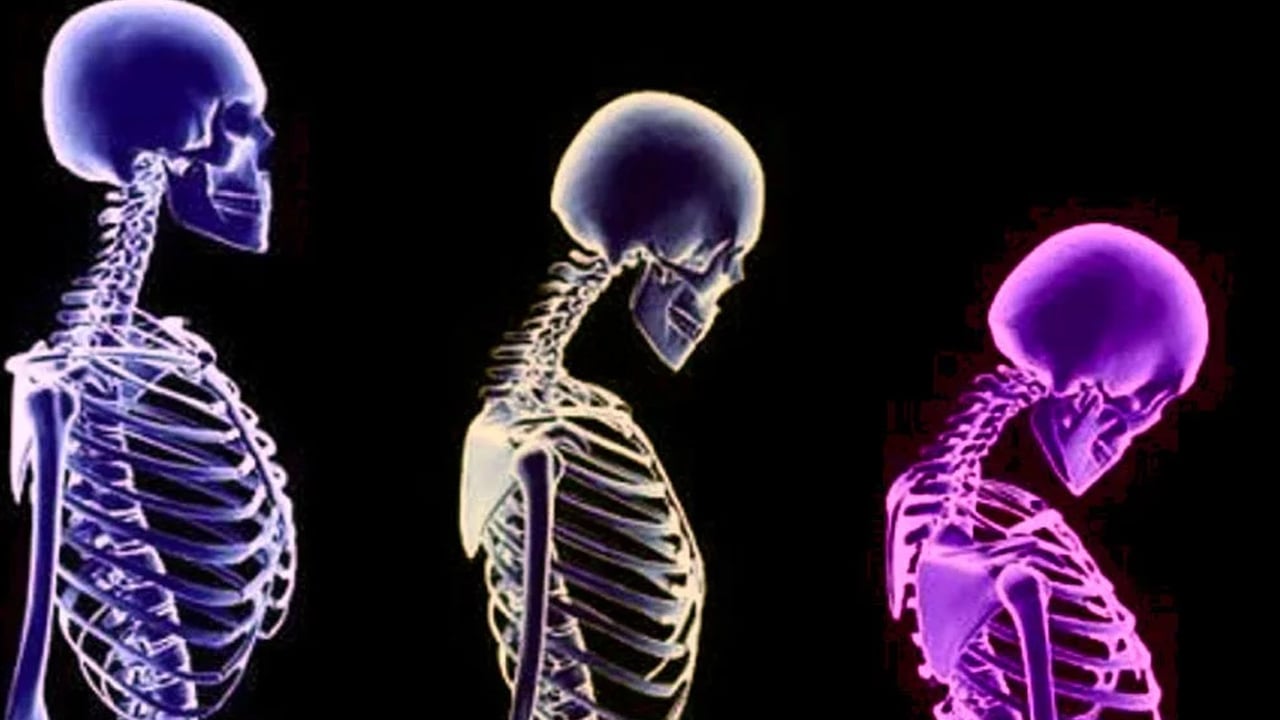 Foto - Kemik erimesi olarak bilinen Osteoporoz yatağa mahkum ediyor! Kemik erimesine karşı 7 etkili öneri