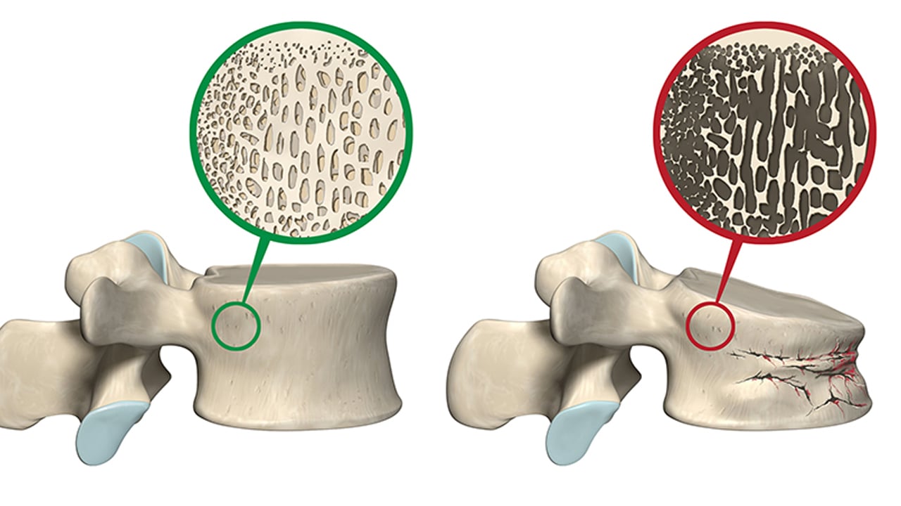 Foto - Kemik erimesi olarak bilinen Osteoporoz yatağa mahkum ediyor! Kemik erimesine karşı 7 etkili öneri