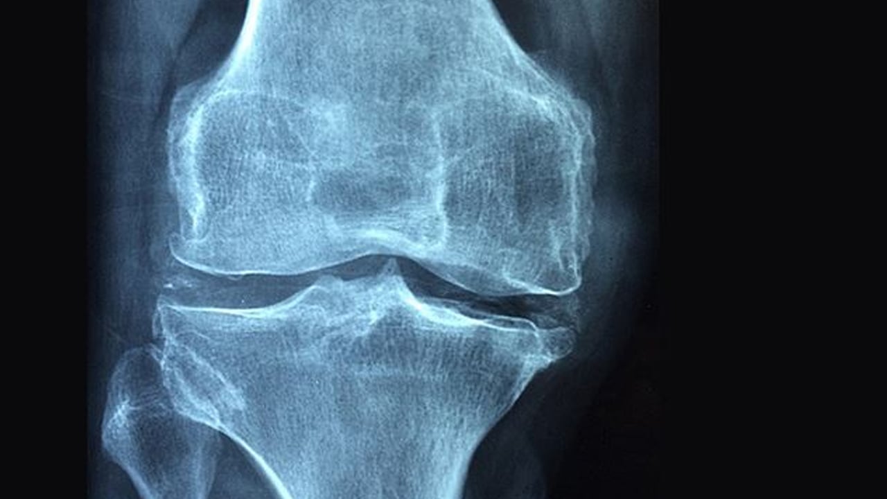 Foto - Kemik erimesi olarak bilinen Osteoporoz yatağa mahkum ediyor! Kemik erimesine karşı 7 etkili öneri