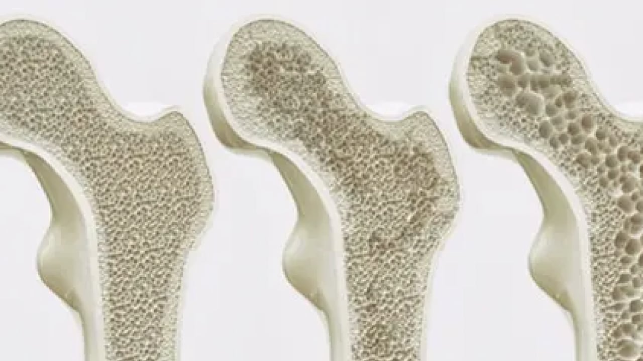 Foto - Kemik erimesine kesin çözüm: Herkesin aklındaki soru! Cevap vereceği konuşuluyor