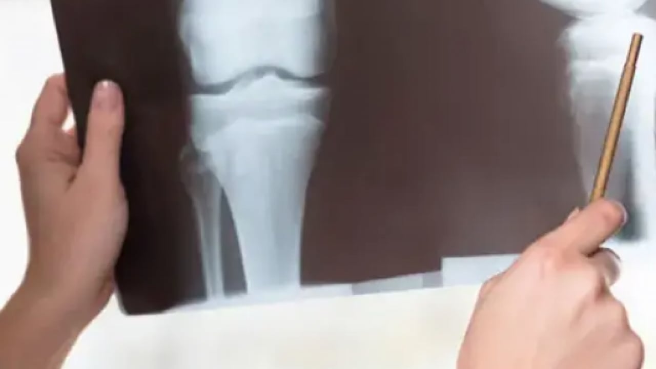 Kemikleri zayıflatan 5 büyük hata: Mineral, K vitamini ve yeşil yapraklı sebzeler...
