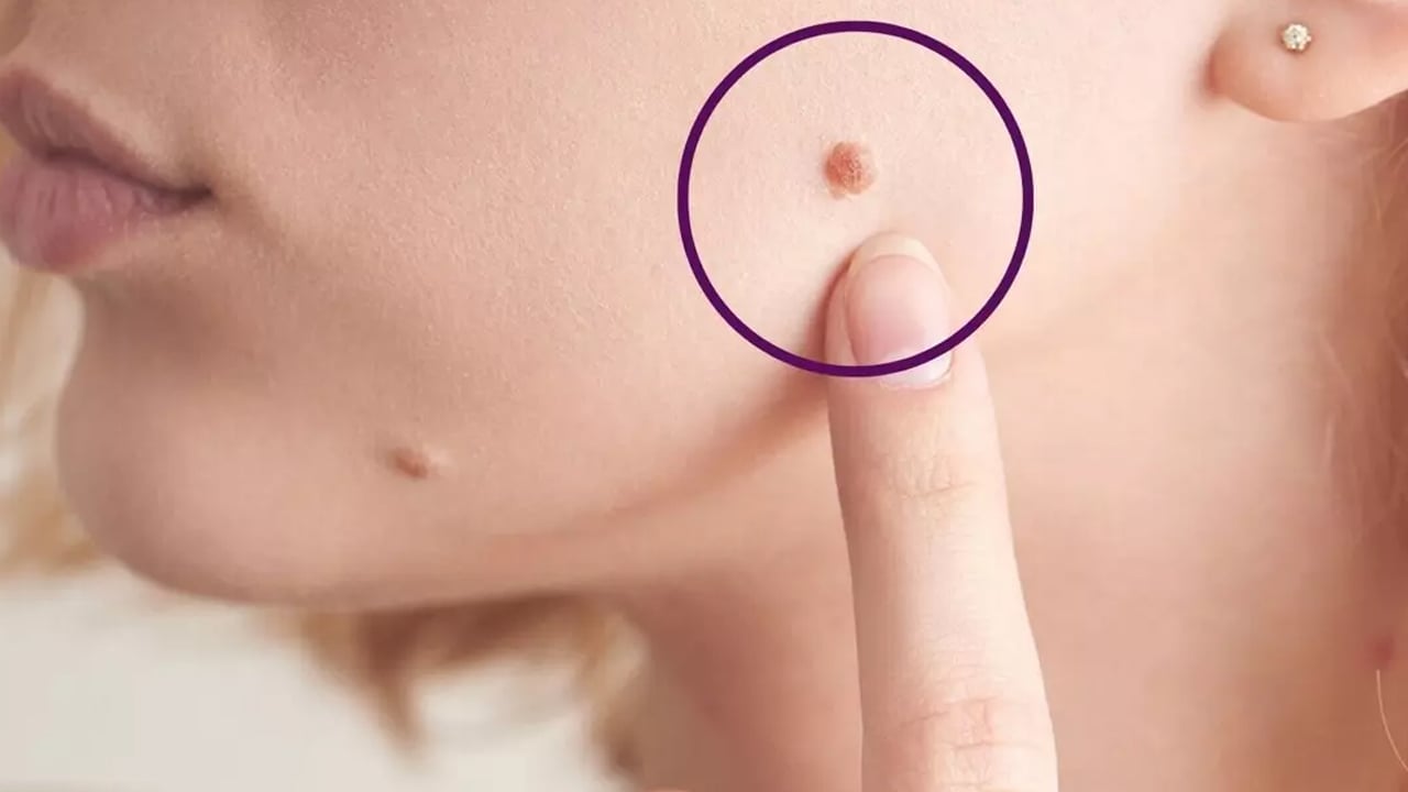 Foto - Kırmızı ben neden olur? Kırmızı et beni tehlikeli midir? İşte iki profesör tek tek anlattı, verilerini açıkladı 