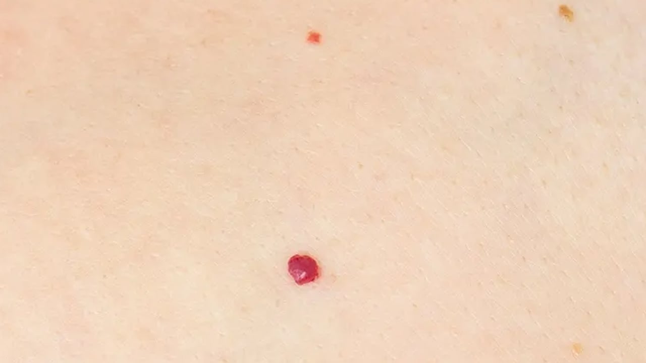 Foto - Kırmızı ben neden olur? Kırmızı et beni tehlikeli midir? İşte iki profesör tek tek anlattı, verilerini açıkladı 