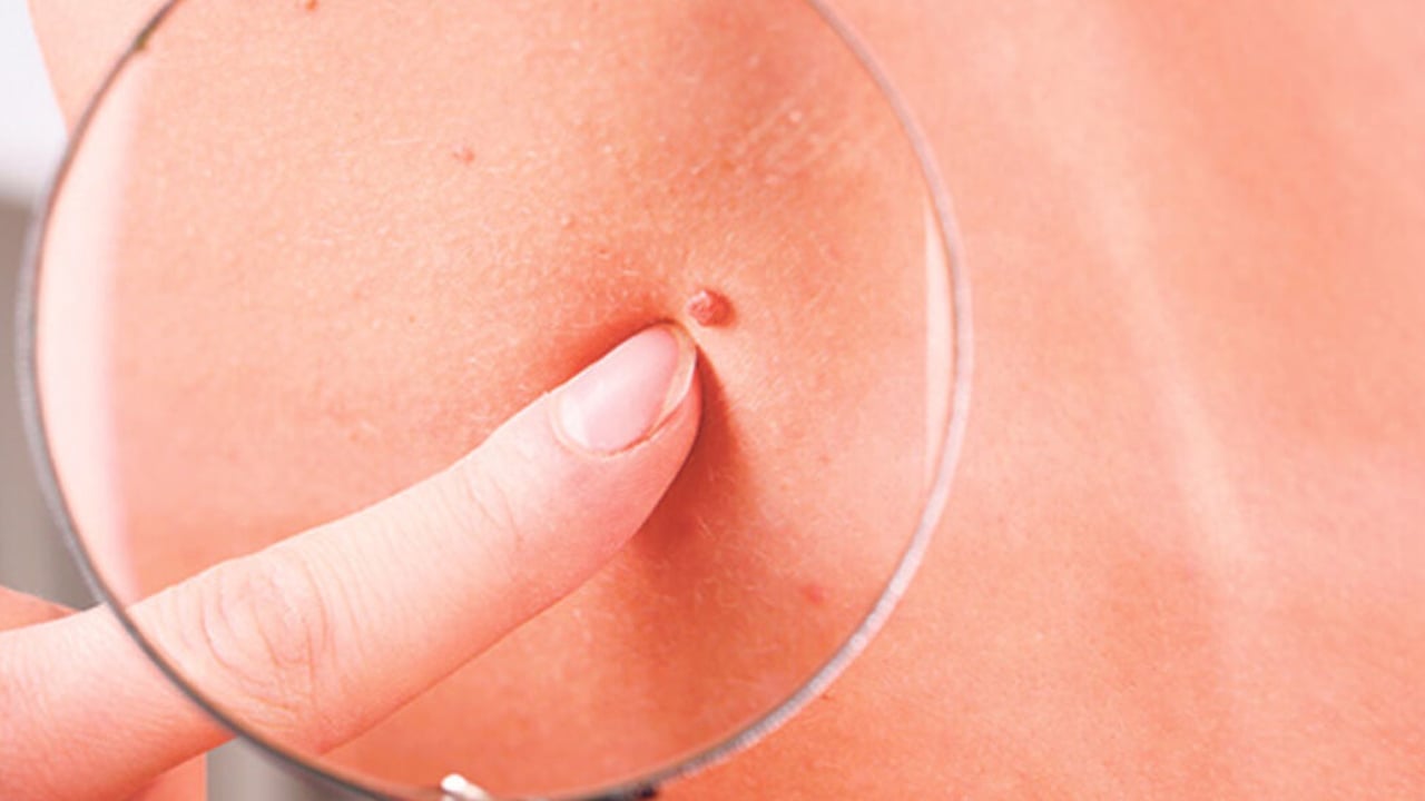 Foto - Kırmızı ben neden olur? Kırmızı et beni tehlikeli midir? İşte iki profesör tek tek anlattı, verilerini açıkladı 