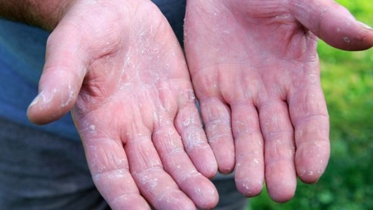 Foto - Kış egzamasına karşı kalkan oluyor! Uzman isim doğal bariyeri açıkladı: Koruyan caydırıcı bir bariyer var