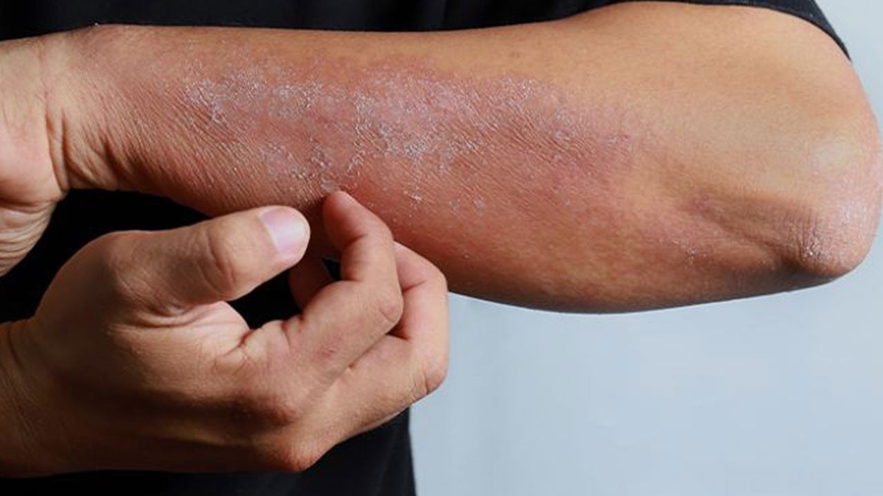 Foto - Kış egzamasına karşı kalkan oluyor! Uzman isim doğal bariyeri açıkladı: Koruyan caydırıcı bir bariyer var