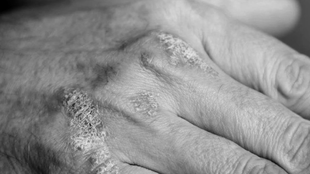 Foto - Kış egzamasına karşı kalkan oluyor! Uzman isim doğal bariyeri açıkladı: Koruyan caydırıcı bir bariyer var