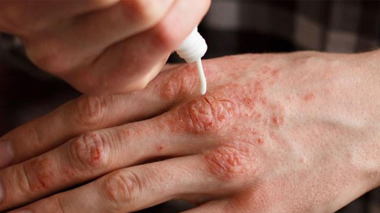 Kış egzamasına karşı kalkan oluyor! Uzman isim doğal bariyeri açıkladı: Koruyan caydırıcı bir bariyer var