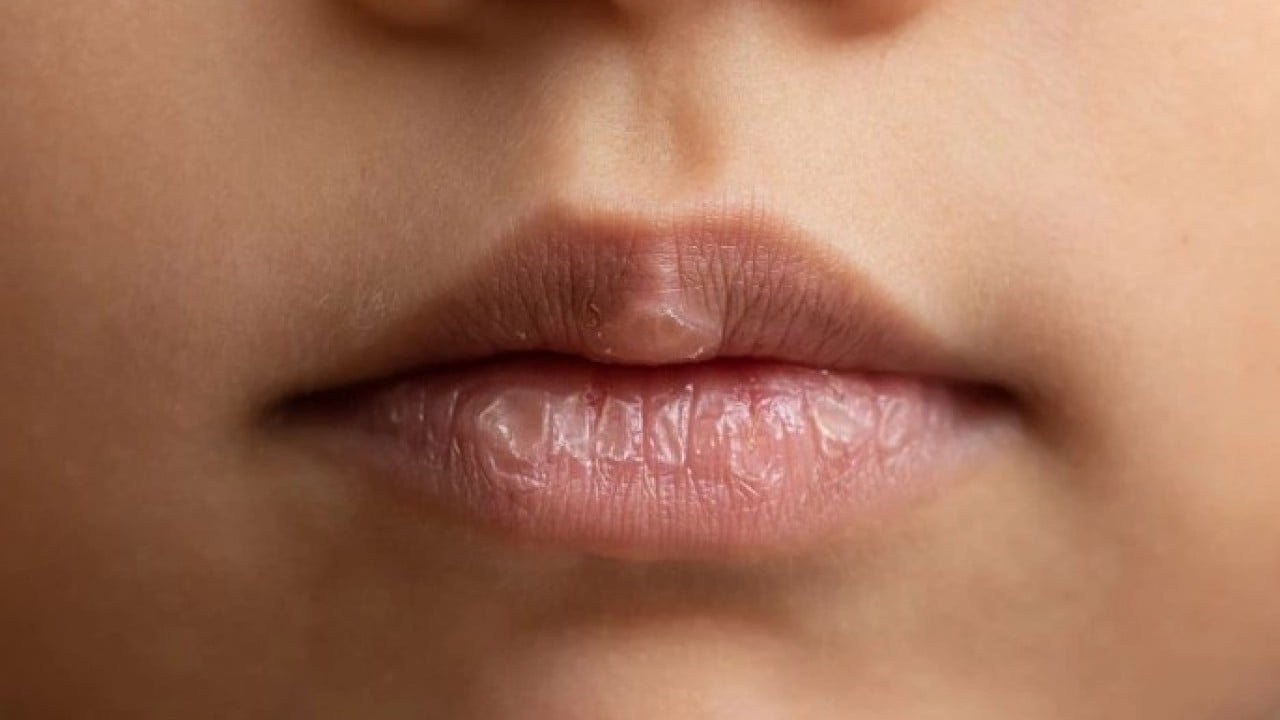 Foto - Kış günleri artık sorun olmayacak! Kuruyan dudakları canlandırmanın doğal yolu