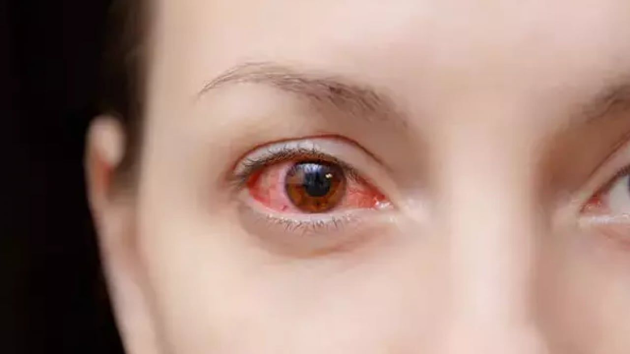 Foto - Kış mevsimi artış yaşanıyor: Gözlerde bu belirtilere dikkat!