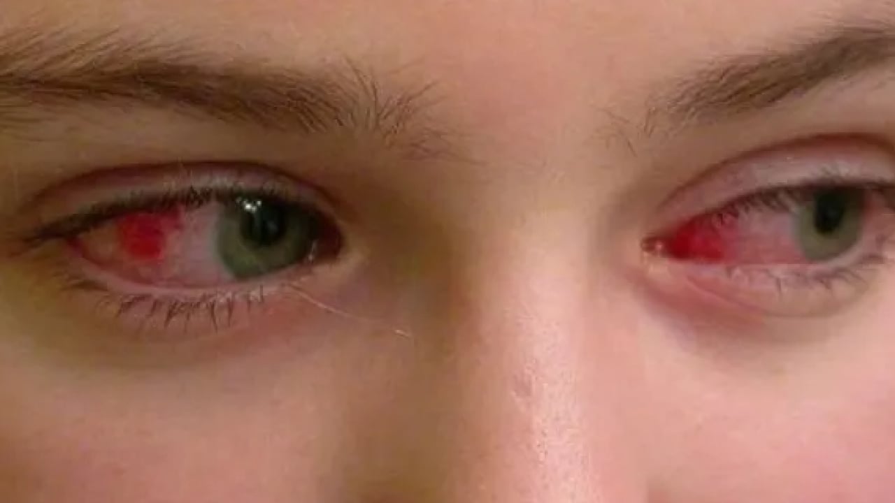 Foto - Kış mevsimi artış yaşanıyor: Gözlerde bu belirtilere dikkat!