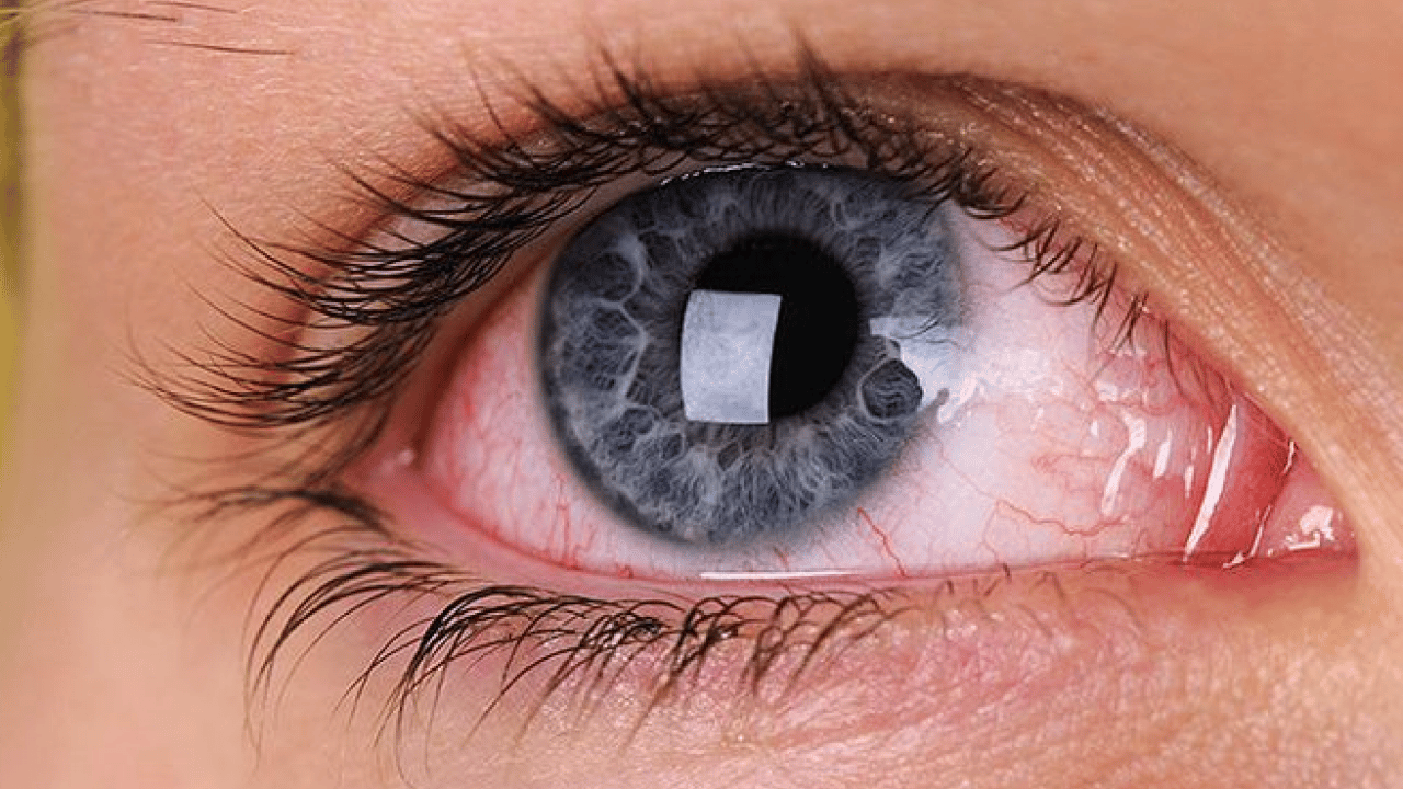 Foto - Kış mevsimi artış yaşanıyor: Gözlerde bu belirtilere dikkat!