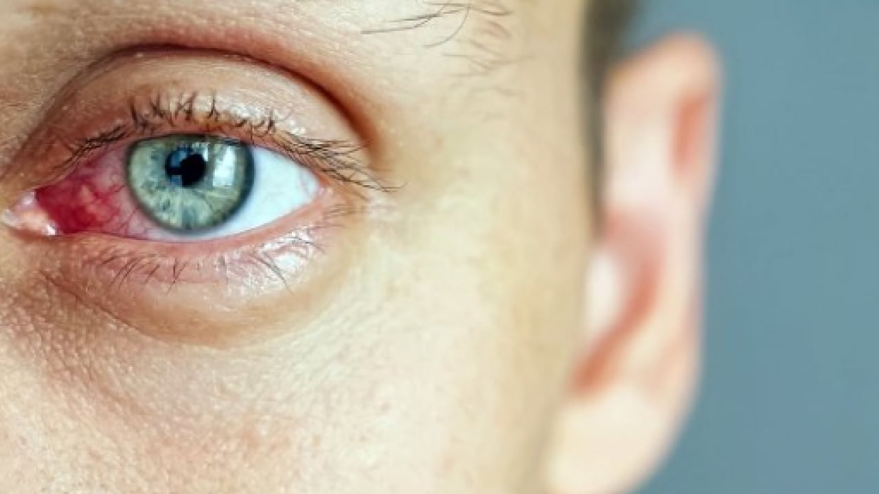 Foto - Kış mevsimi artış yaşanıyor: Gözlerde bu belirtilere dikkat!