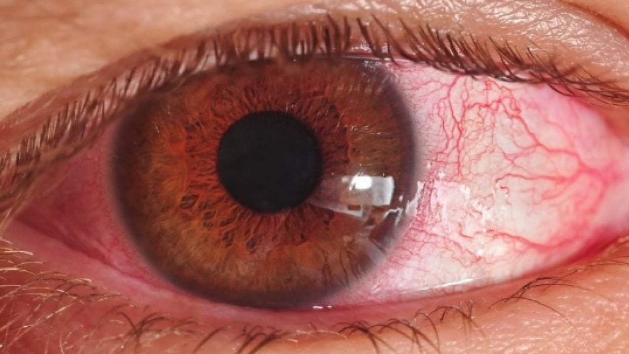 Foto - Kış mevsimi artış yaşanıyor: Gözlerde bu belirtilere dikkat!