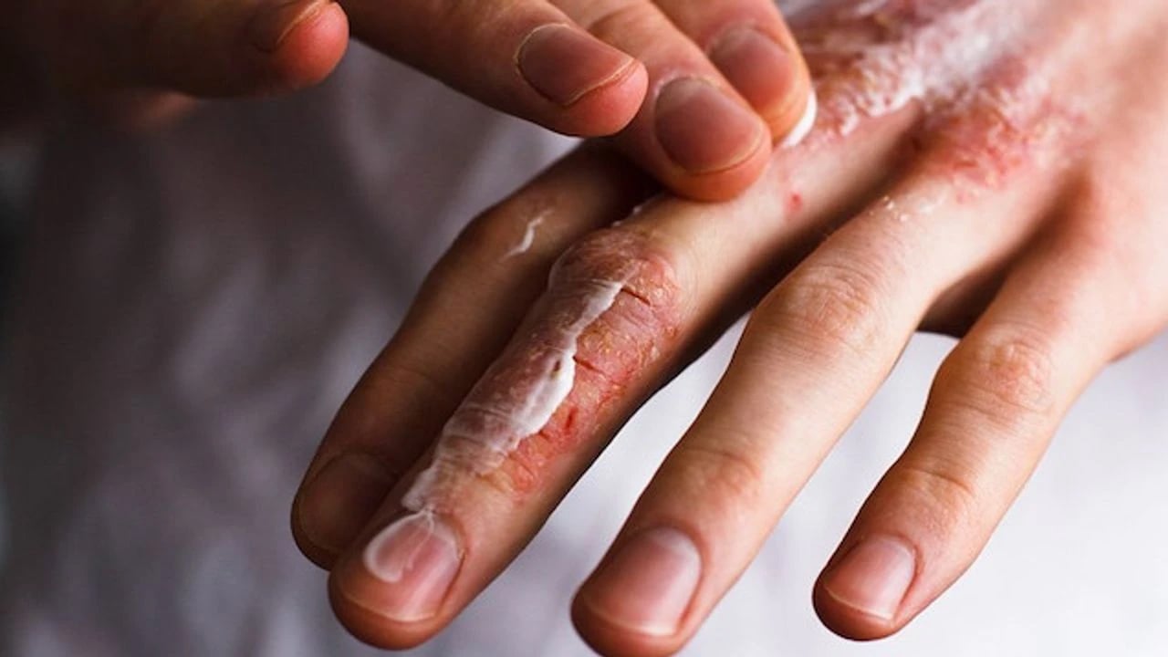 Foto - Kış sert geliyor dikkat! Kışın en kötü hastalık bu: Basit kızarıklık deyip geçmeyin! 