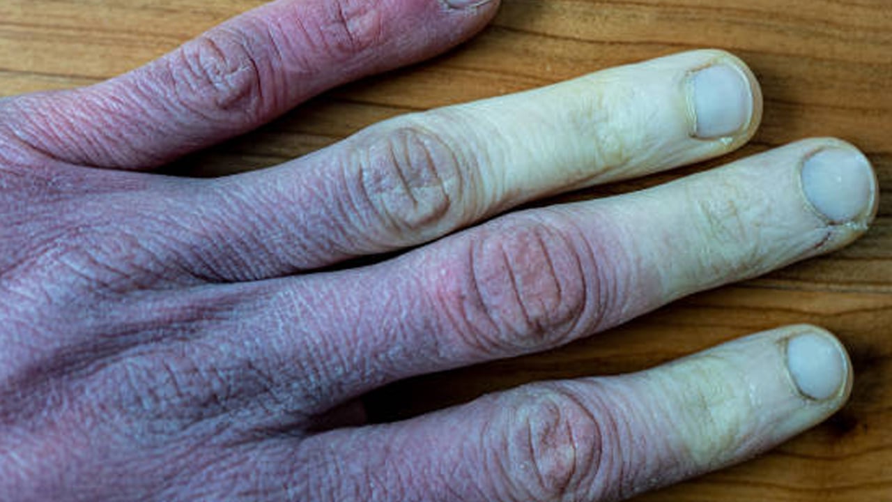 Foto - Kış sert geliyor dikkat! Kışın en kötü hastalık bu: Basit kızarıklık deyip geçmeyin! 