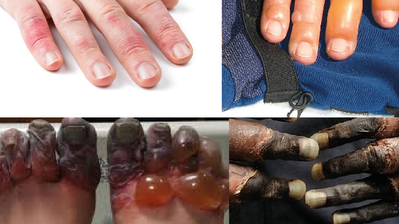 Foto - Kış sert geliyor dikkat! Kışın en kötü hastalık bu: Basit kızarıklık deyip geçmeyin! 