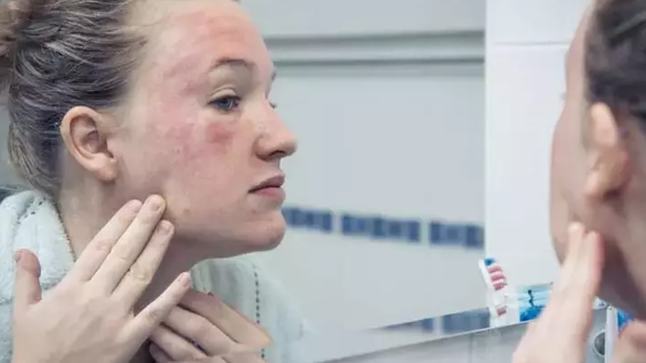 Kış sert geliyor dikkat! Kışın en kötü hastalık bu: Basit kızarıklık deyip geçmeyin! 