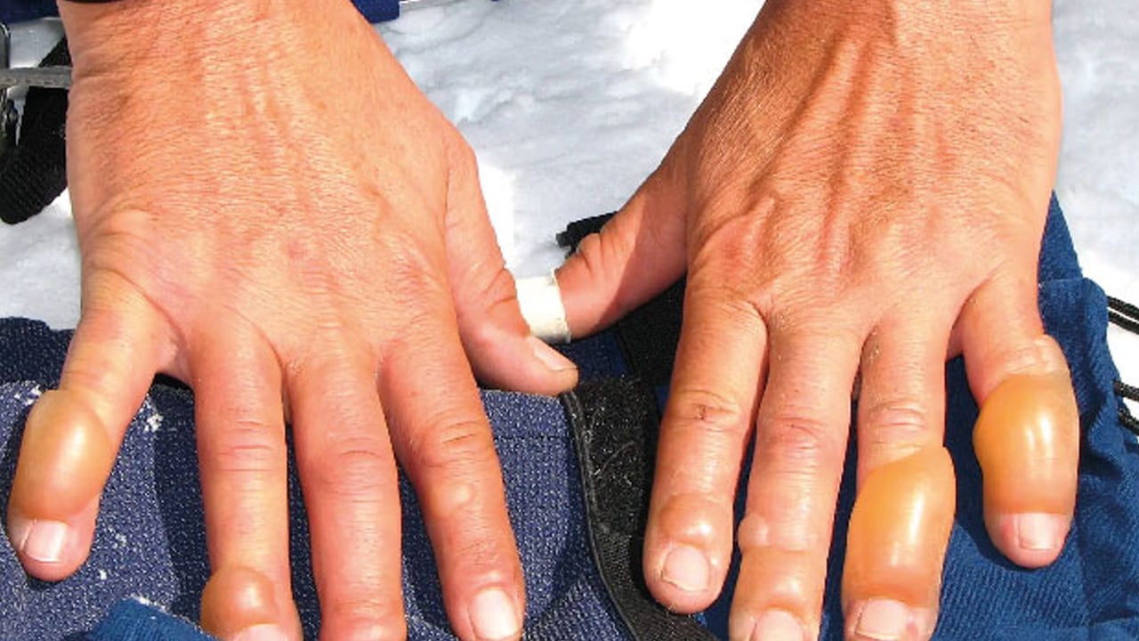 Foto - Kış sert geliyor dikkat! Kışın en kötü hastalık bu: Basit kızarıklık deyip geçmeyin! 