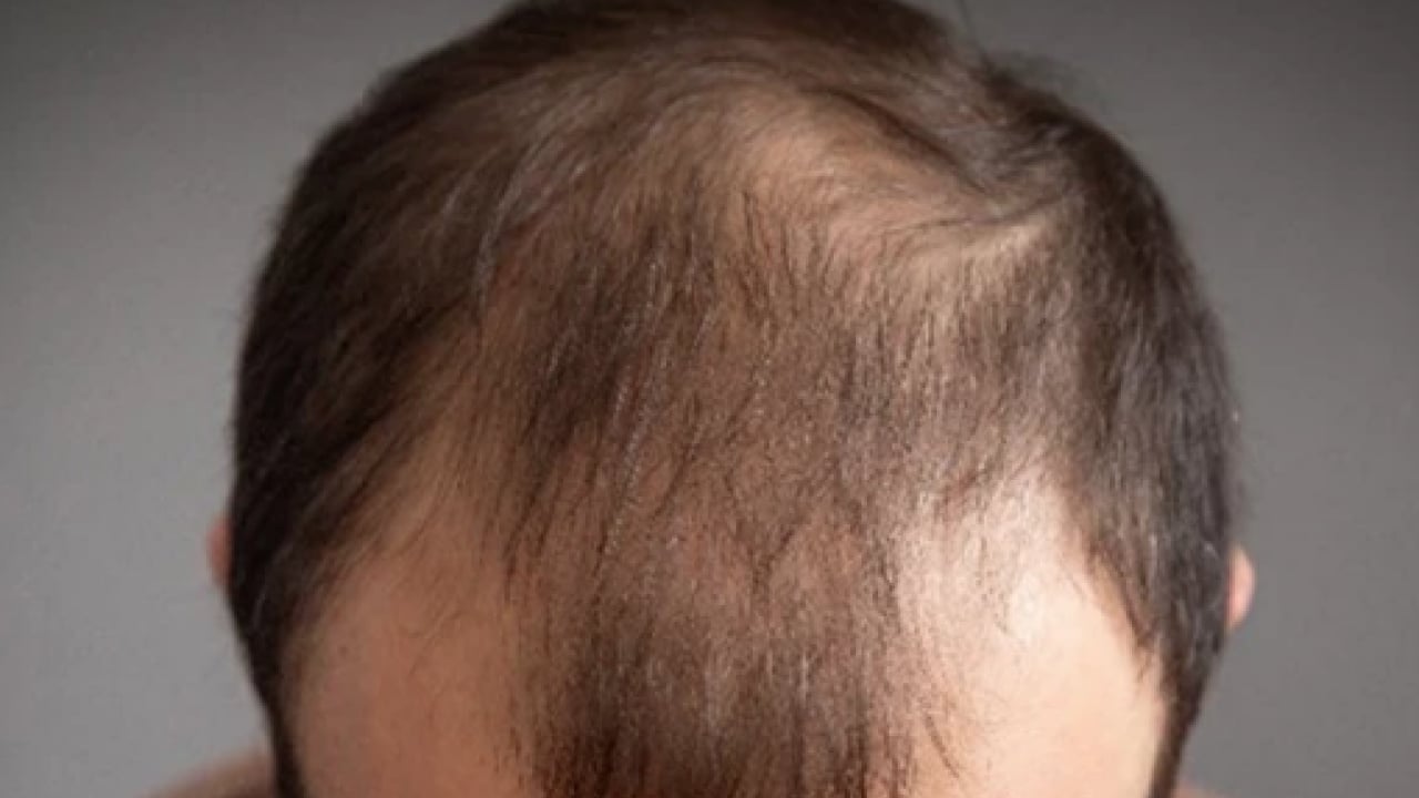 Foto - Saç dökülmesi artıyorsa mutlaka deneyin: En çok uygulanan doğal formül etkisini sürdürmeye devam edecek