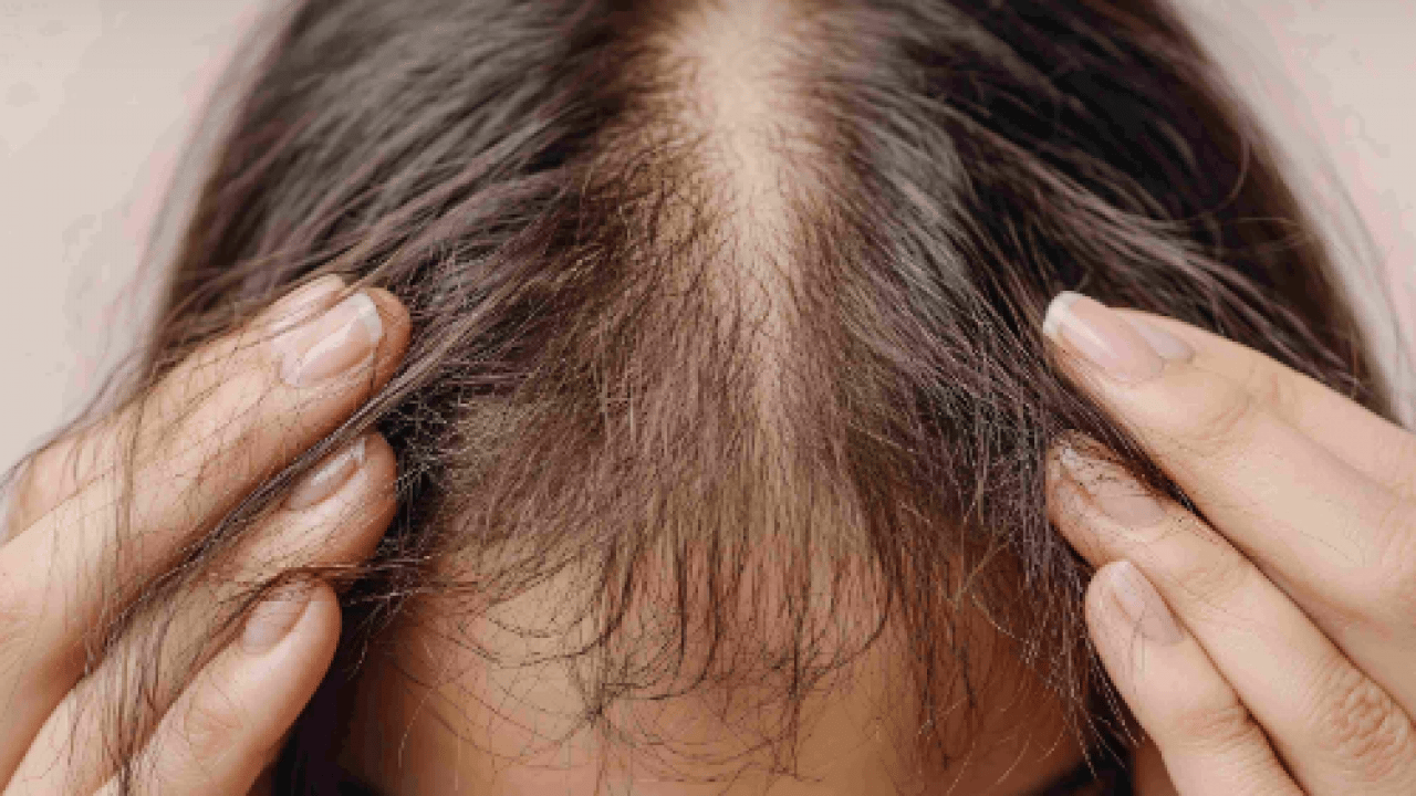 Foto - Saç dökülmesi artıyorsa mutlaka deneyin: En çok uygulanan doğal formül etkisini sürdürmeye devam edecek