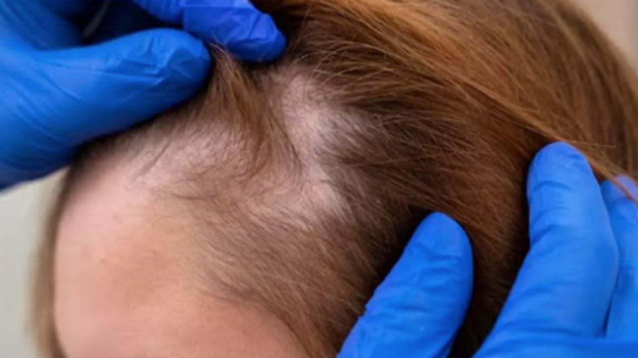 Foto - Saç dökülmesi artıyorsa mutlaka deneyin: En çok uygulanan doğal formül etkisini sürdürmeye devam edecek