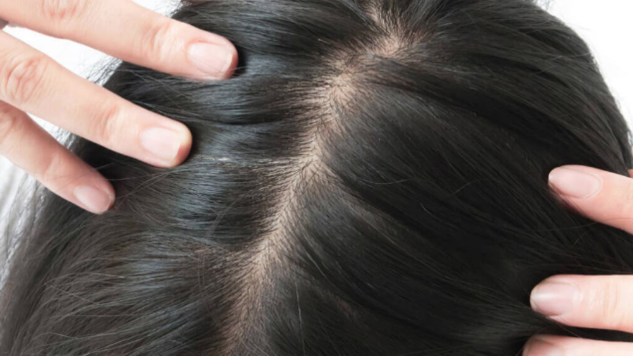 Saç dökülmesi artıyorsa mutlaka deneyin: En çok uygulanan doğal formül etkisini sürdürmeye devam edecek