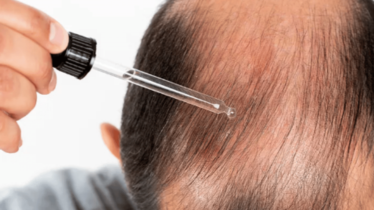 Foto - Saç dökülmesi artıyorsa mutlaka deneyin: En çok uygulanan doğal formül etkisini sürdürmeye devam edecek