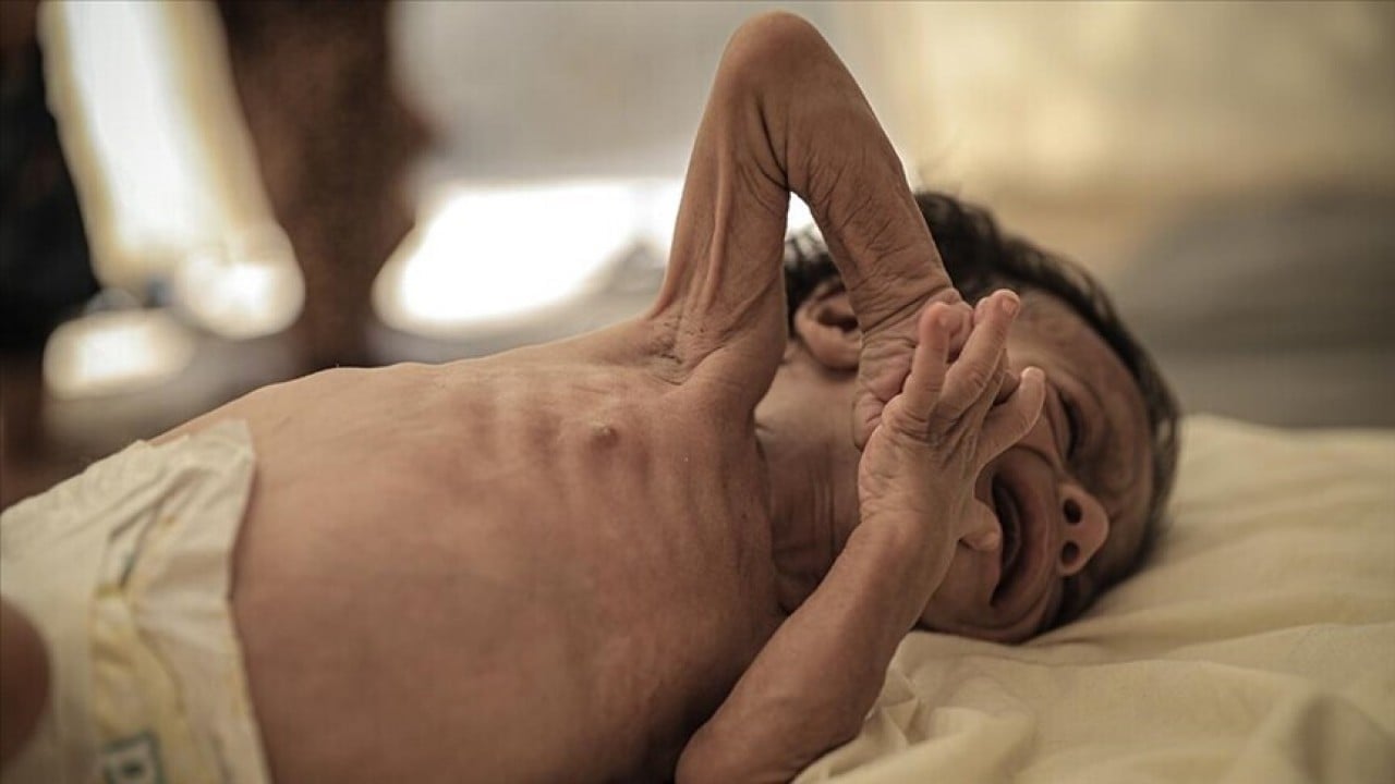Kızamık alarmı! 528 çocuk hayatını kaybetti 