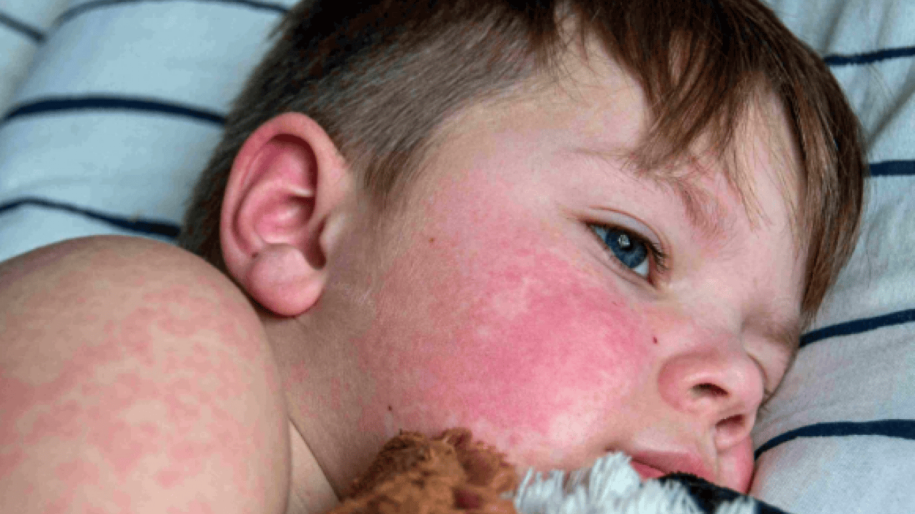 Foto - Kızamıkta aşı karşıtlığı uyarısı! Uzman isim tek tek açıkladı.. Mutlaka not edin!