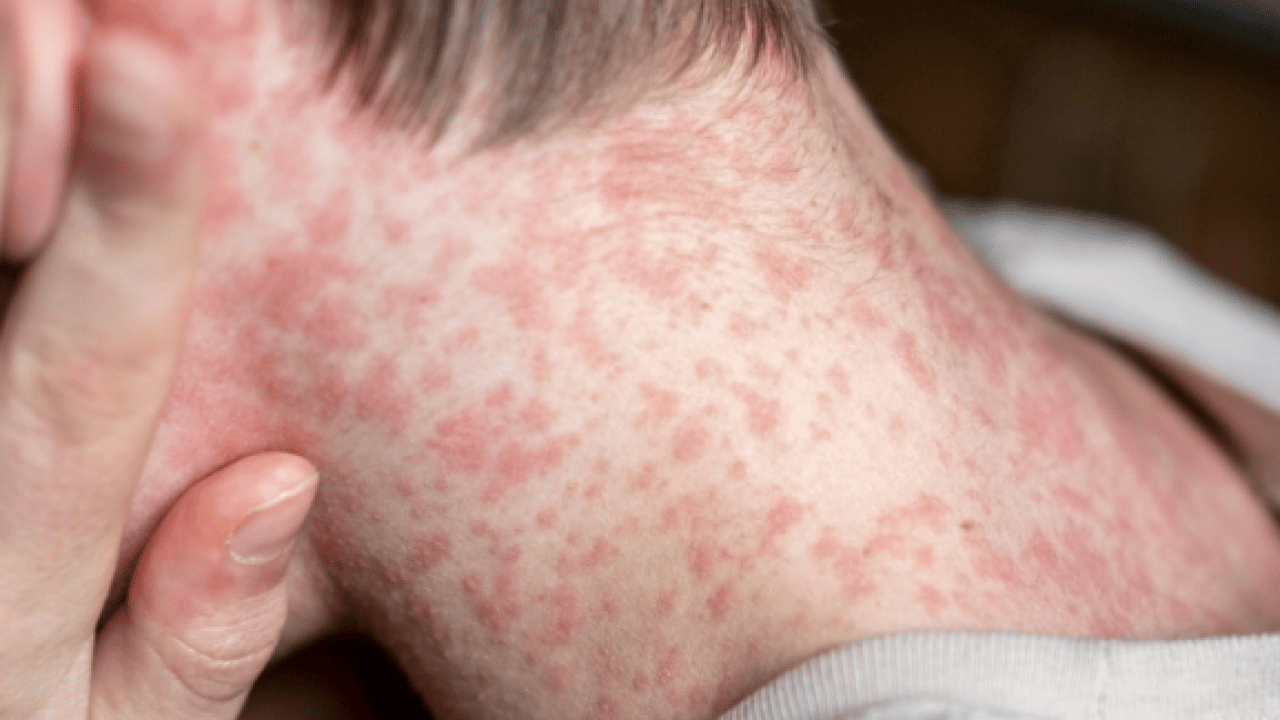 Foto - Kızamıkta aşı karşıtlığı uyarısı! Uzman isim tek tek açıkladı.. Mutlaka not edin!