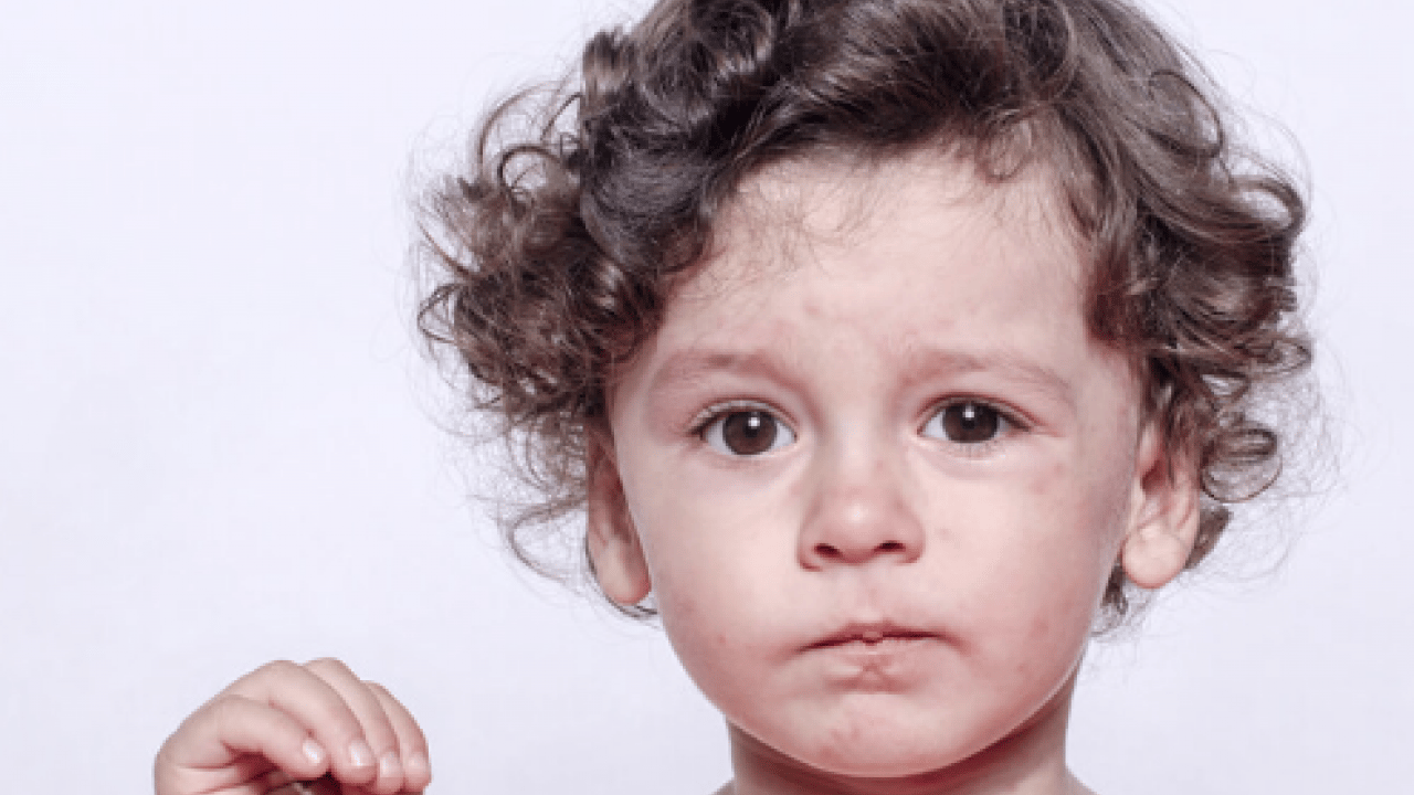 Foto - Kızamıkta aşı karşıtlığı uyarısı! Uzman isim tek tek açıkladı.. Mutlaka not edin!