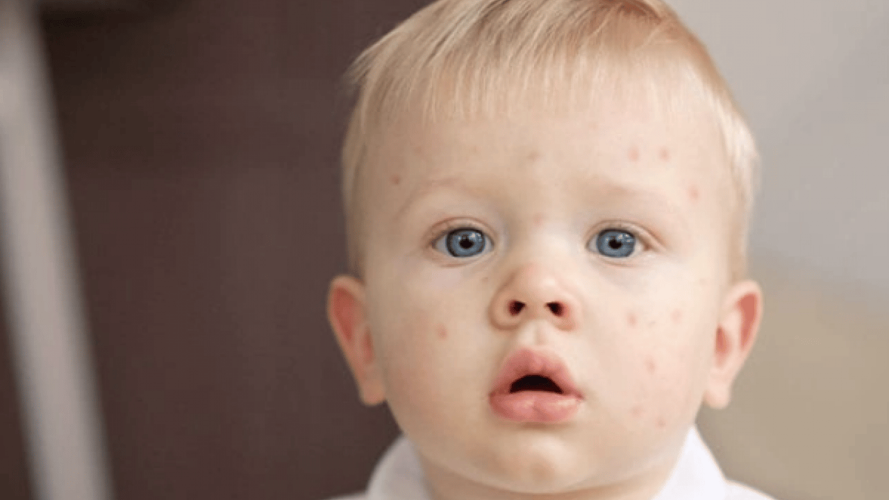 Foto - Kızamıkta aşı karşıtlığı uyarısı! Uzman isim tek tek açıkladı.. Mutlaka not edin!