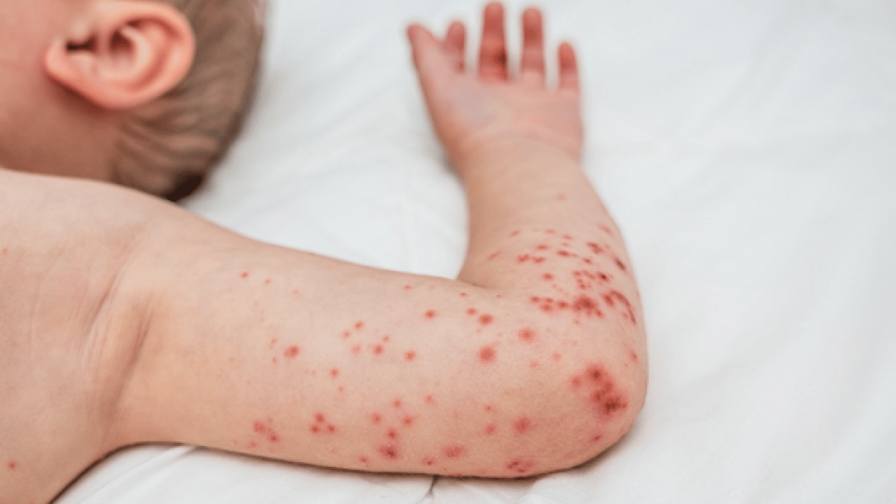 Kızamıkta aşı karşıtlığı uyarısı! Uzman isim tek tek açıkladı.. Mutlaka not edin!