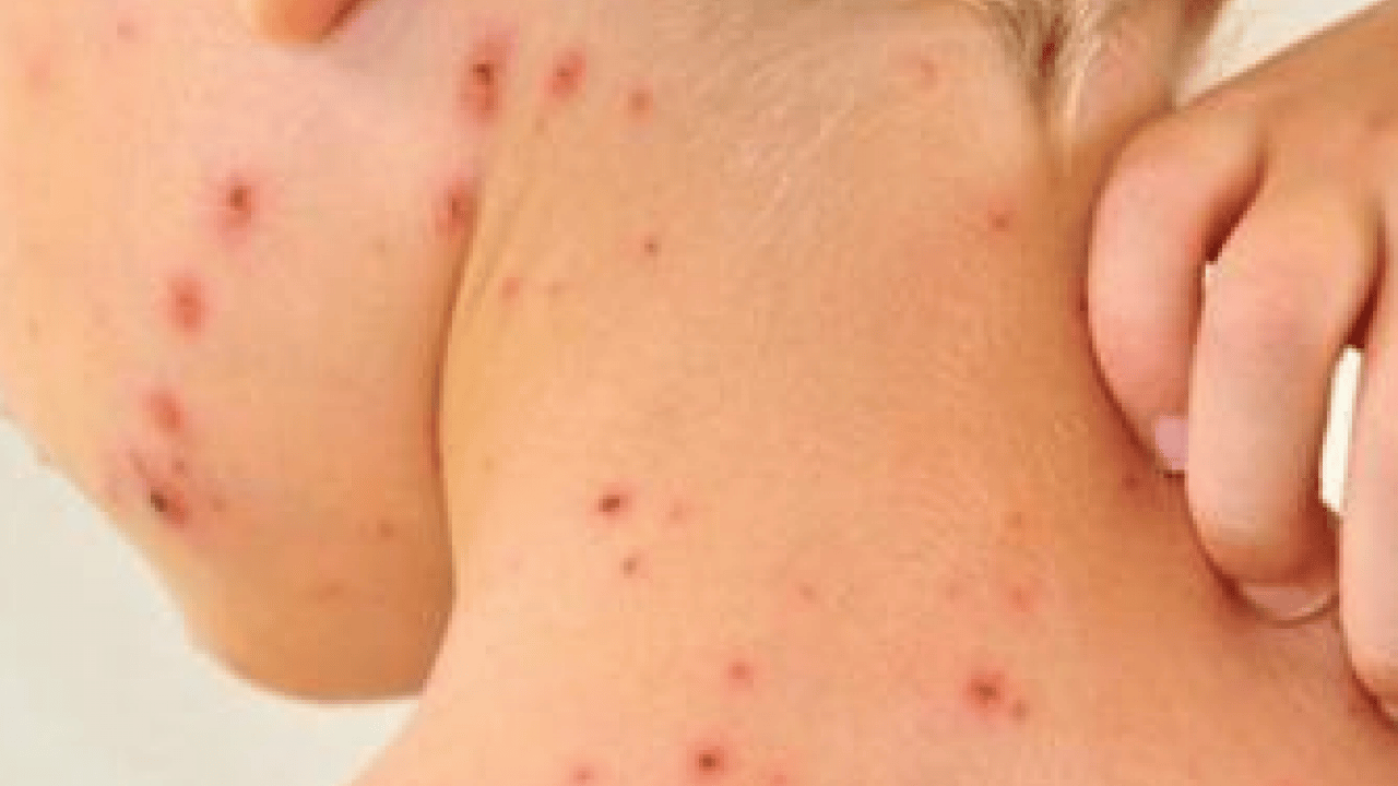 Foto - Kızamıkta aşı karşıtlığı uyarısı! Uzman isim tek tek açıkladı.. Mutlaka not edin!