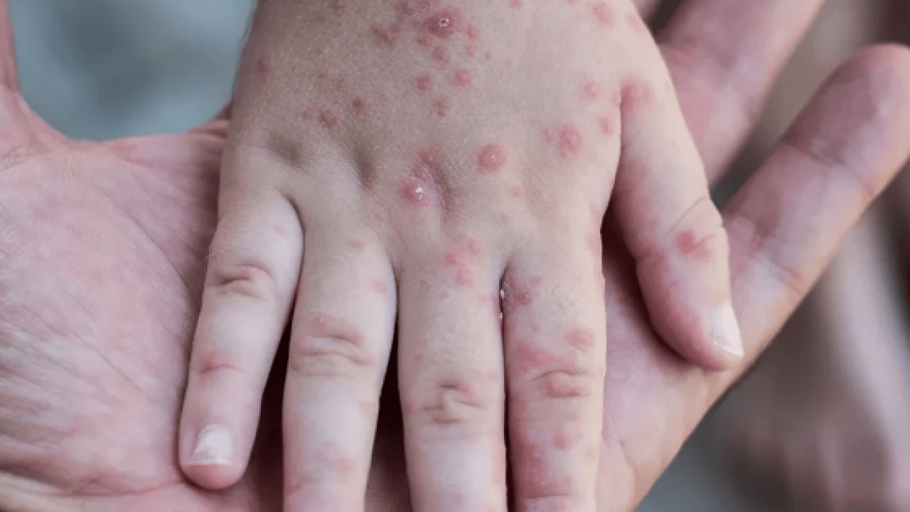 Foto - Kızamıkta aşı karşıtlığı uyarısı! Uzman isim tek tek açıkladı.. Mutlaka not edin!